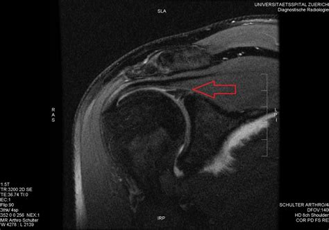 tests for glenoid labrum tear massage therapist|An Inside Look at Labral Tears .